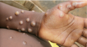 monkeypox